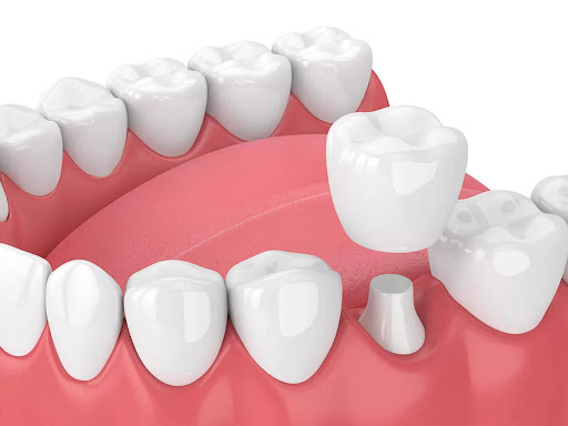 Implant Crowns
